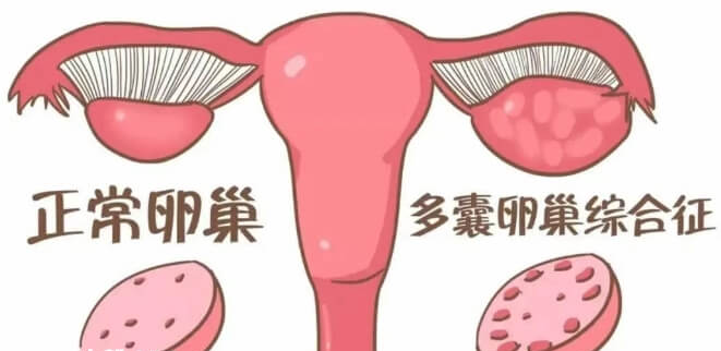 多囊卵巢综合征