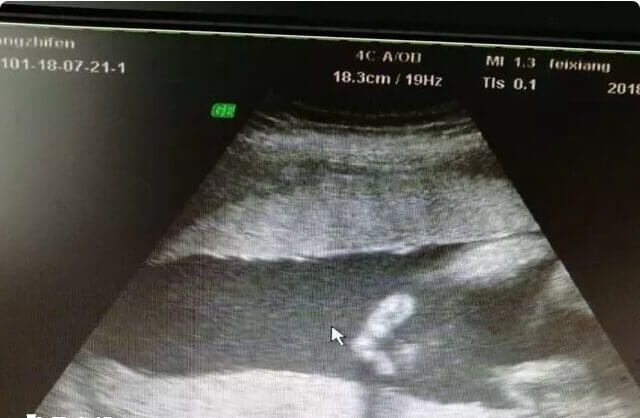 y精子也可以通过生殖系彩超检查健康状态