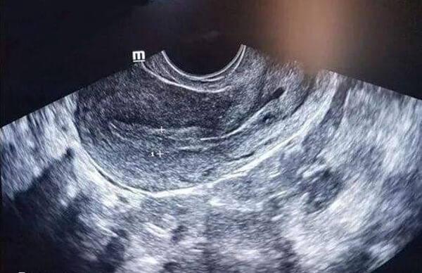子宫内膜是胚胎植入最重要的地方