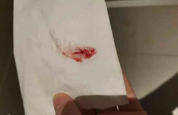 胚胎着床过程会引起少量出血