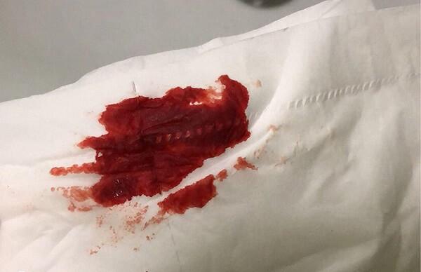 试管移植后出血可能是正常的