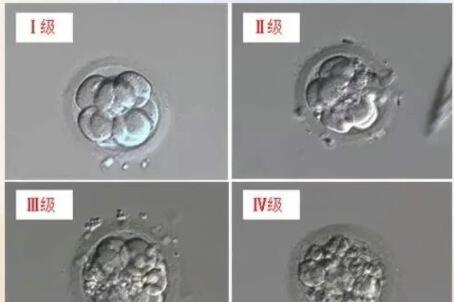 8细胞胚胎分四个等级