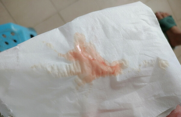 子宫出血是排卵障碍的症状之一