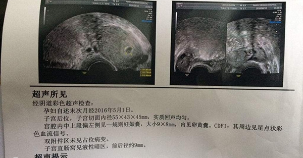 月经不调备孕做妇科彩超