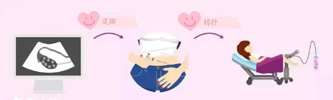 促排取卵过程