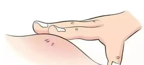 肌注黄体酮后可能出现硬结