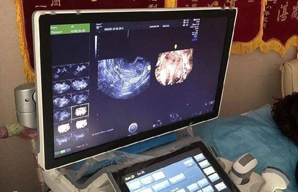 妇科超声是备孕前必做的检查项目之一