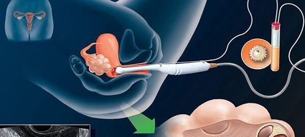 试管婴儿取卵中会冲卵