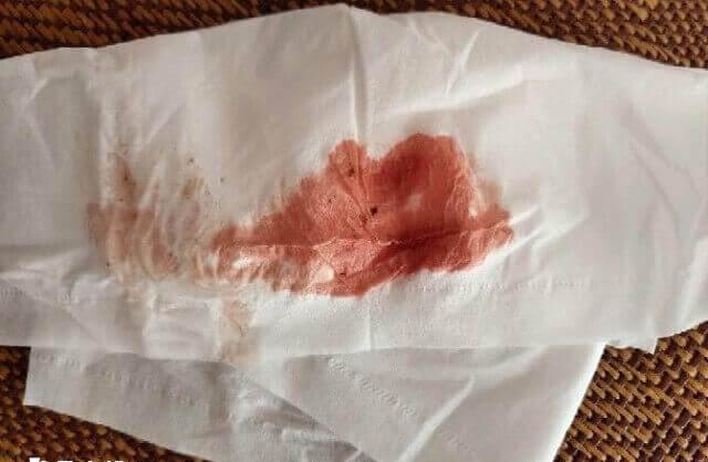 不规则出血可能不利于胚胎移植