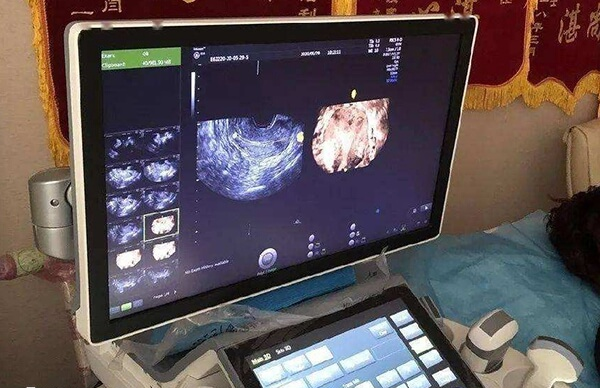 超声检查可以观察子宫和卵巢的形态