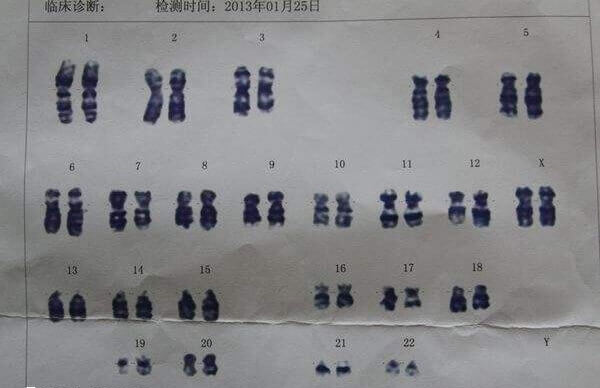 染色体47xxx是超雌综合征