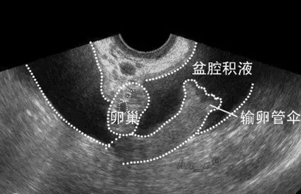 盆腔炎是最常见的妇科疾病之一