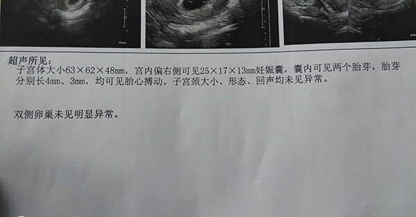 子宫环境不好不建议双胎妊娠