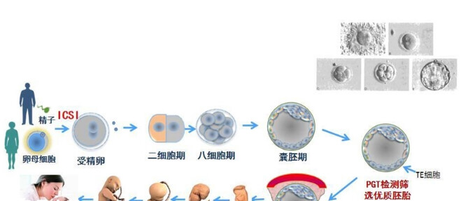 试管婴儿的助孕流程