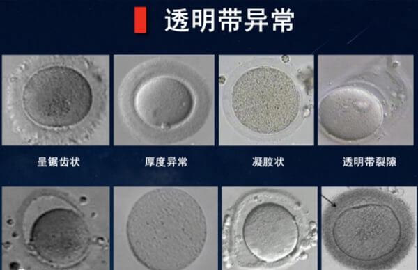 卵子透明带形态异常情况