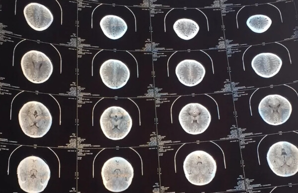 多发性骨软骨瘤是一种常染色体显性遗传病