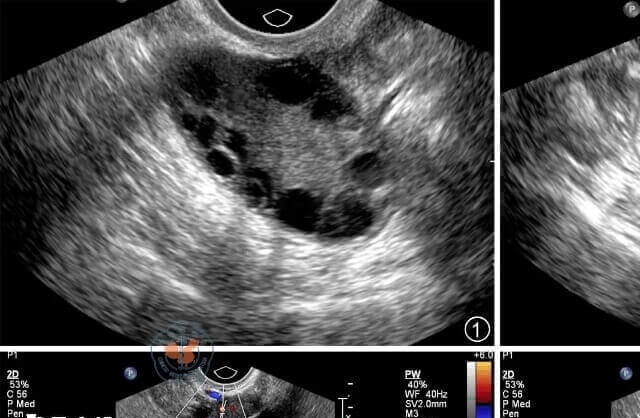 多囊卵巢综合征会引起多个小卵泡