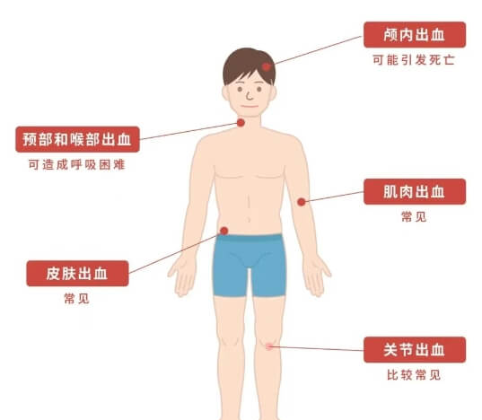 血友病是一种罕见的遗传性出血性疾病