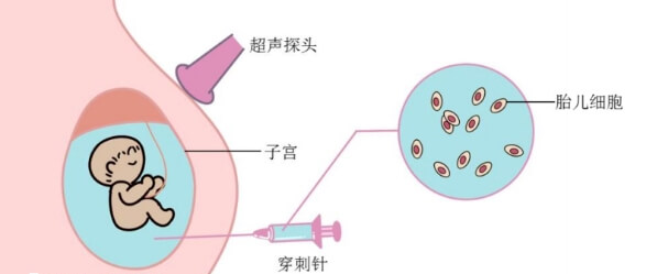 羊水穿刺示意图
