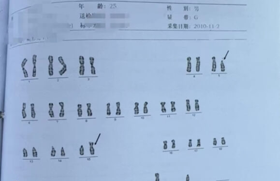 染色体5号15号平衡易位