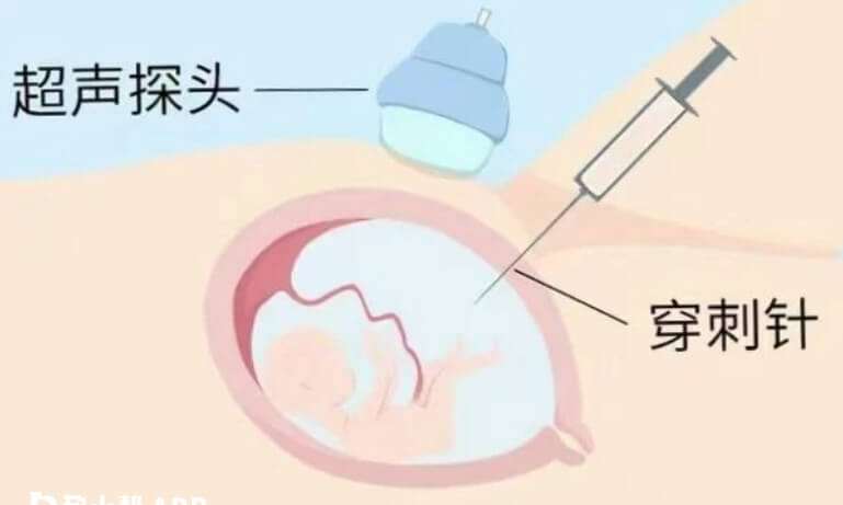 三代试管婴儿要做羊水穿刺