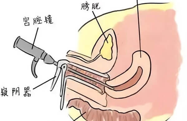 宫腔镜手术会对女性身体产生一些影响