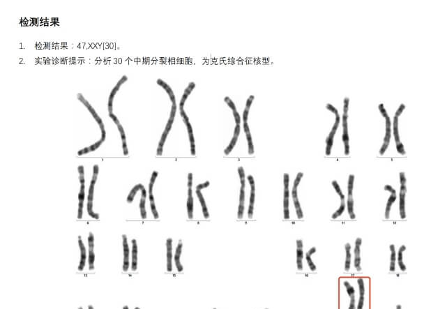 克氏综合征