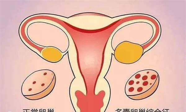拮抗剂方案适合多囊卵巢综合征患者
