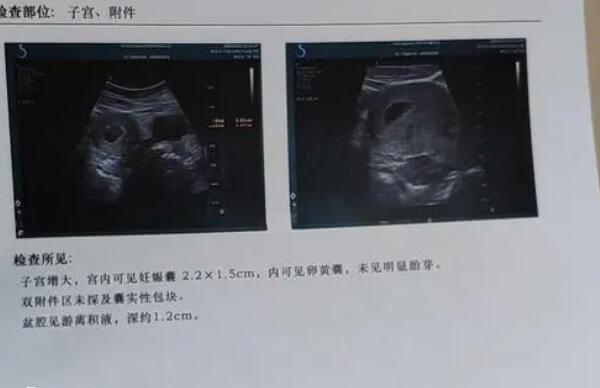 移植优胚不一定都是生儿子