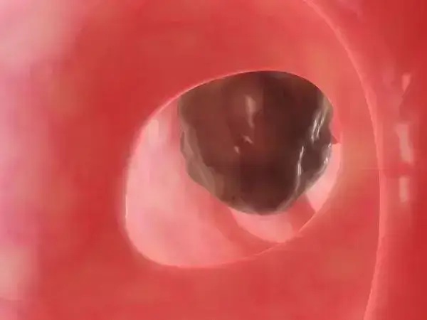 阑尾炎是常见的急腹症之一