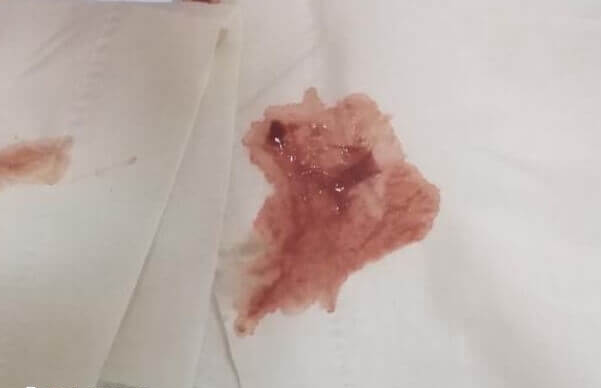 着床出血的样子图