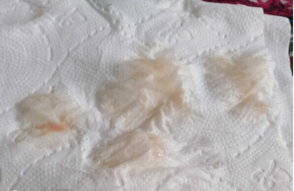 胚胎移植失败后的分泌物图