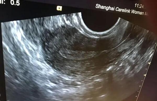 宫腔内人工授精非性交方式助孕