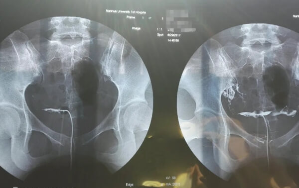 桥本甲状腺炎做试管婴儿可以做造影
