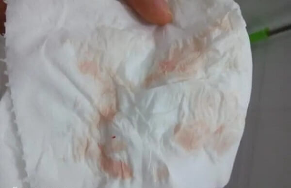 少量的阴道出血一般给予止血药物
