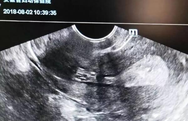 子宫内膜的厚度对胚胎着床至关重要