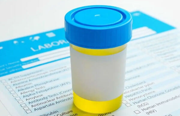 尿常规检查要选择晨尿