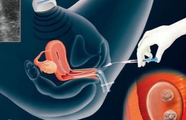 人授想比试管婴儿时间成本更低
