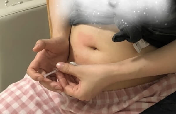 打促排后注射部位可能出现红肿