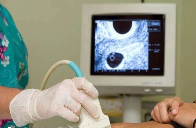 排卵障碍是监测不出卵泡的原因之一