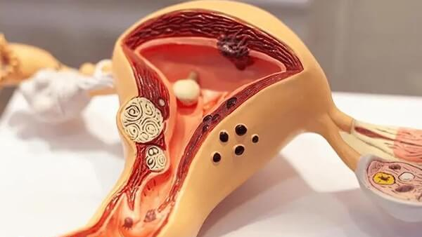 子宫内膜薄影响试管婴儿成功率