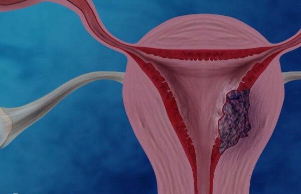 子宫发育畸形是内膜薄的原因之一