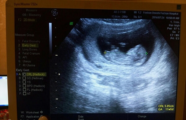 试管移植成功后查B超是看孕囊位置