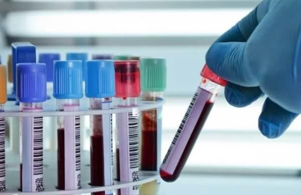 抽血检查hcg数值