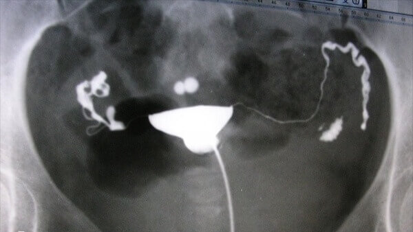 受孕成功率低是不建议人工授精的原因之一