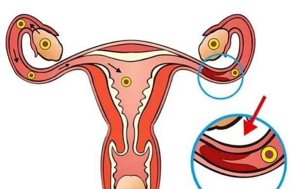 月经不调是输卵管堵塞的症状