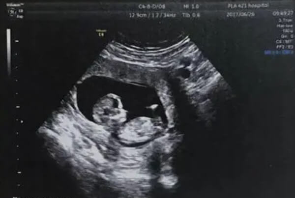 双胞胎小排畸重点检查脑部