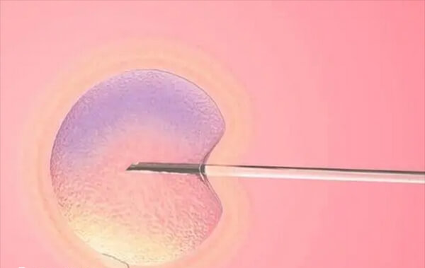 清除肠道粪便可避免肠管膨胀遮挡卵巢视野