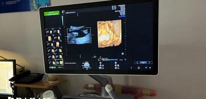 阴超比经腹部超声更加清晰