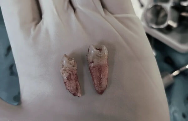 拔牙过程中的疼痛可能导致身体应激反应